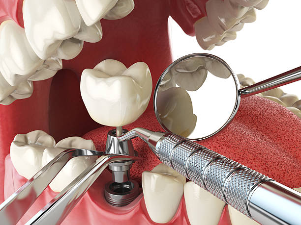 Best Knocked-Out Tooth (Avulsed Tooth) Treatment in West Loch Estate, HI